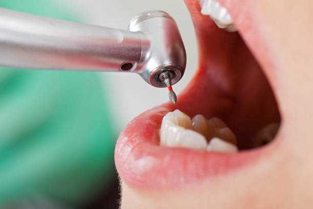 Best Emergency Tooth Extraction in Mcloud, OK